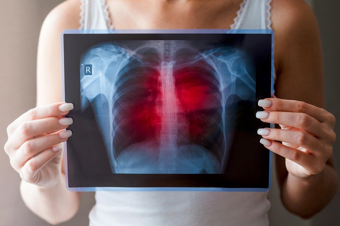 How does Catching COVID-19 Affect my Lung Condition?